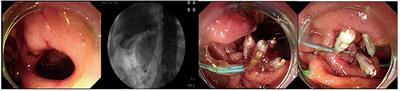 Clinical analysis of 45 cases of perforation were identified during endoscopic retrograde cholangiopancreatography procedure